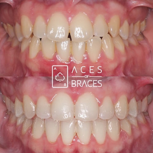 aces of braces league city tx smile gallery image