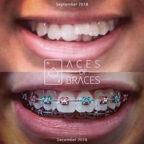 aces of braces league city tx smile gallery image