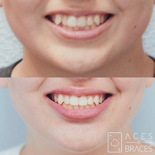 aces of braces league city tx smile gallery image