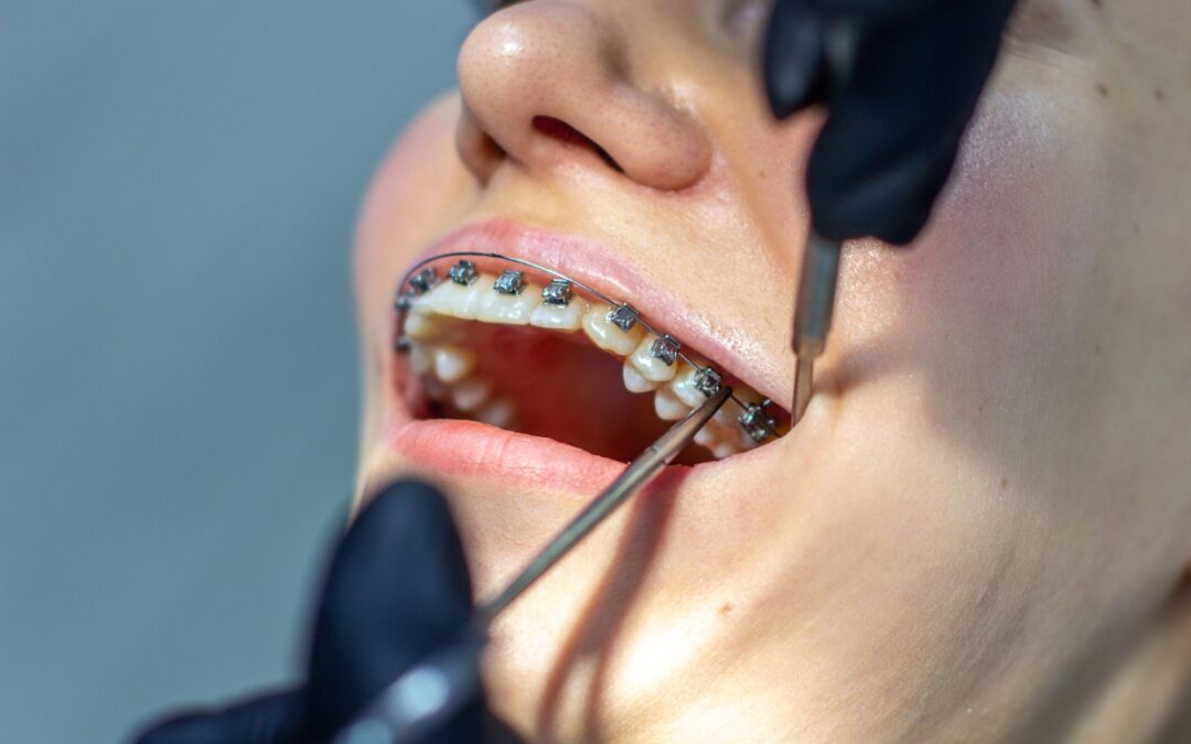 How Long Does It Take to Get Braces? A Step-by-Step Timeline for Patients