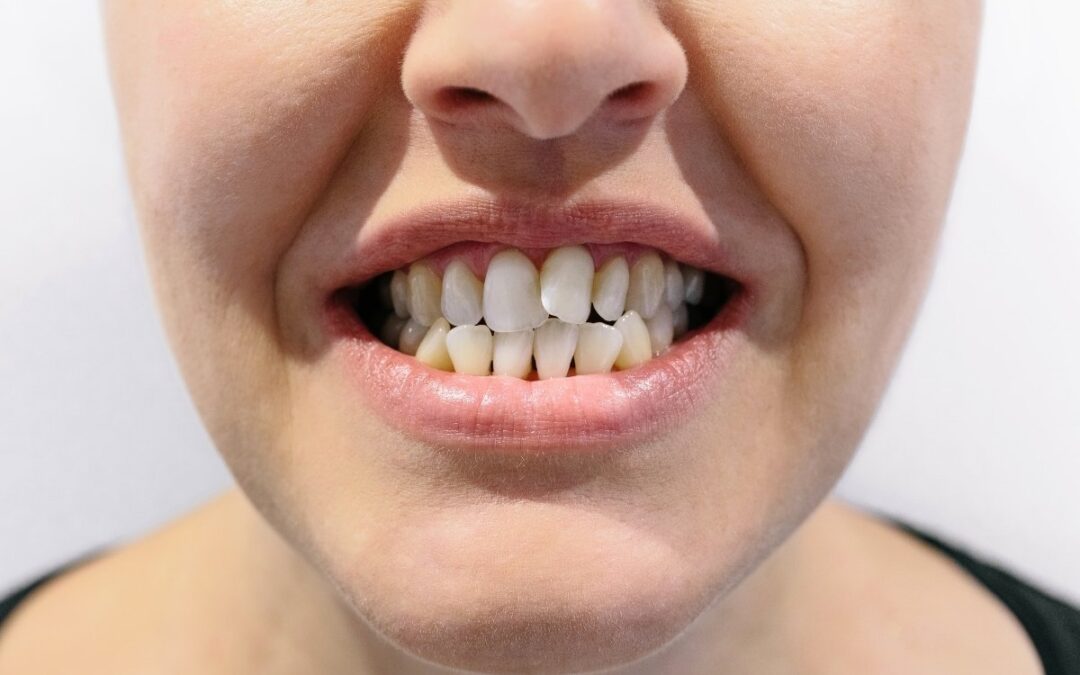 Can Invisalign Fix an Overbite? Here’s What You Need to Know
