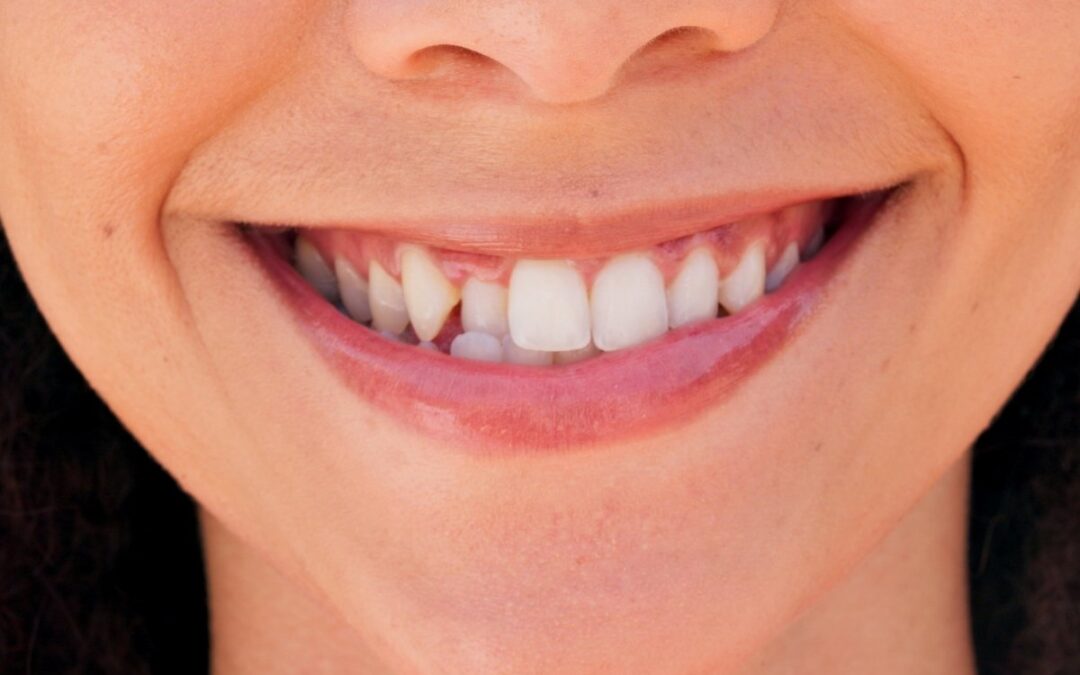 Can an Orthodontist Fix a Chipped Tooth?