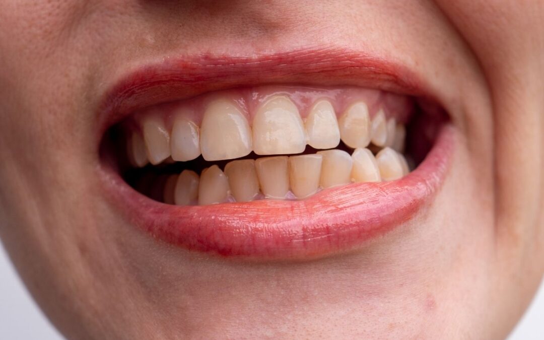 Chapped Lips Causes: Why Your Lips Are Always Dry
