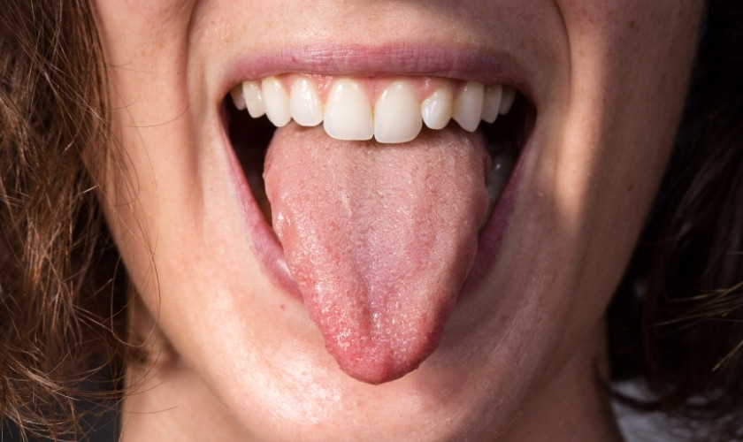 How to Get Rid of White Tongue