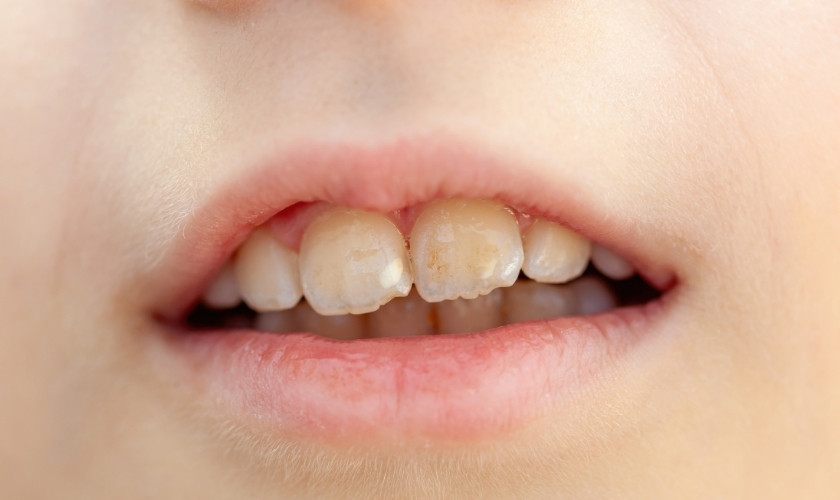 How to Get Rid of White Spots on Teeth?