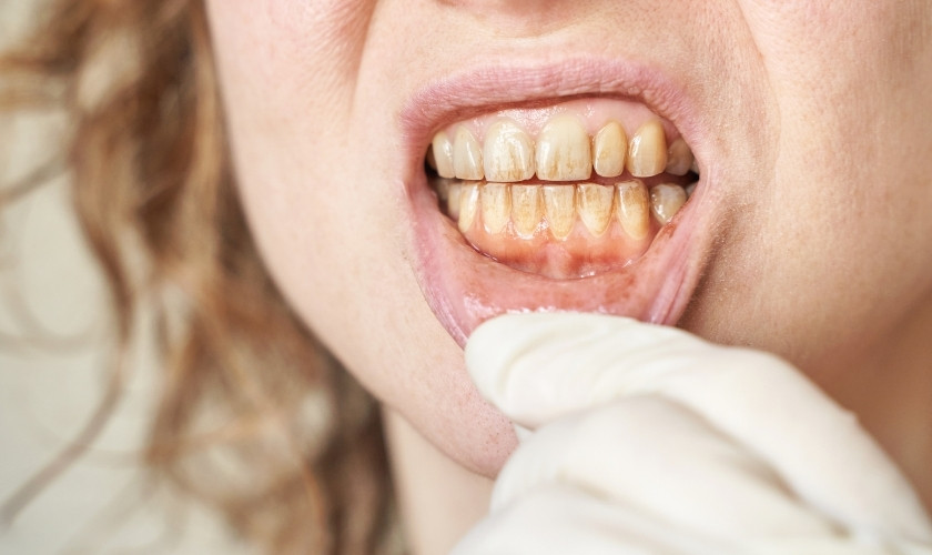 Fix Craze Lines in Teeth