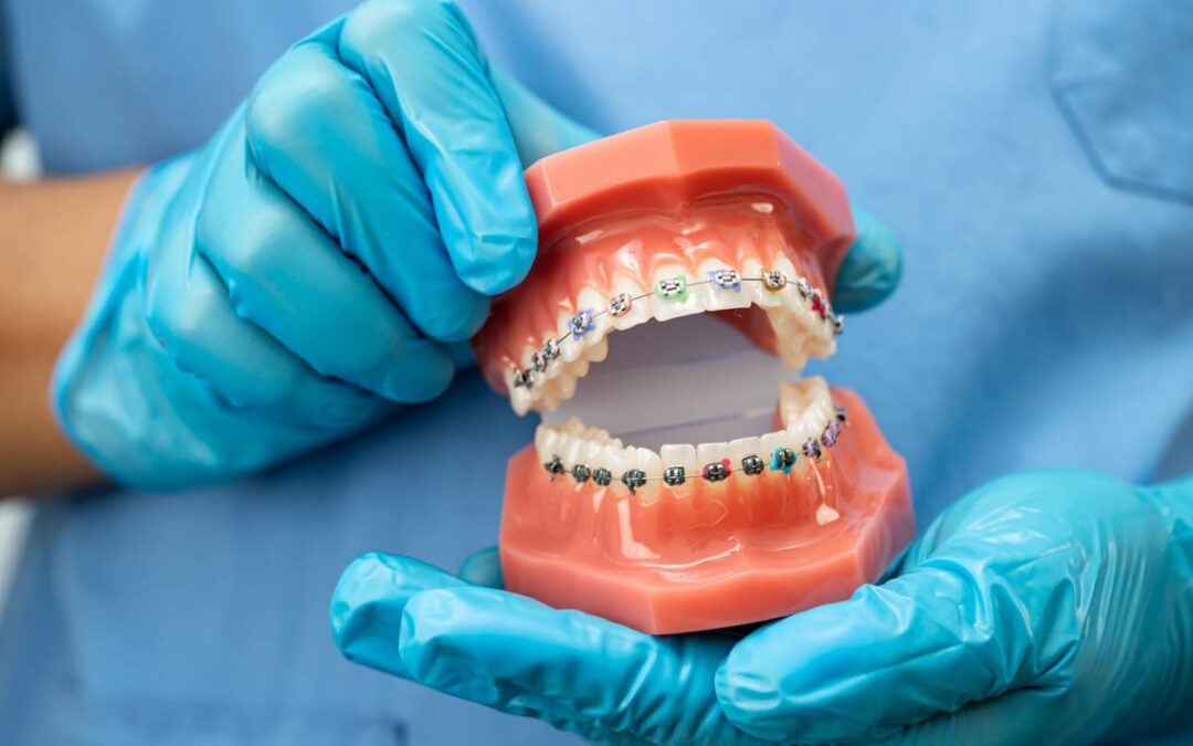 After Braces Recovery Timeline in League City, TX