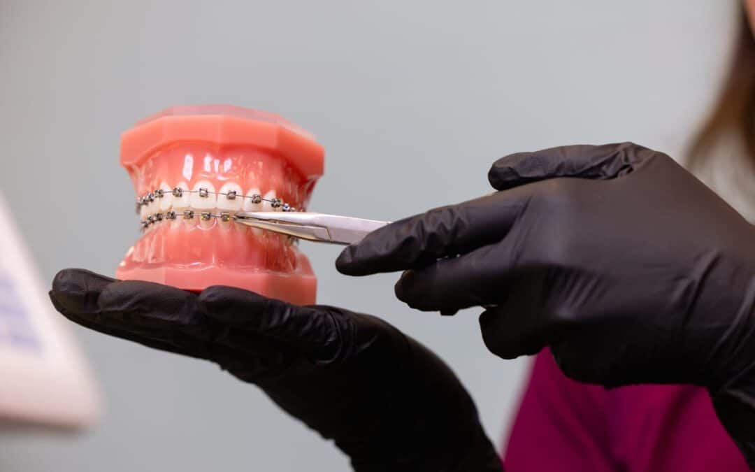 After Braces Aftercare Guide in Webster, TX