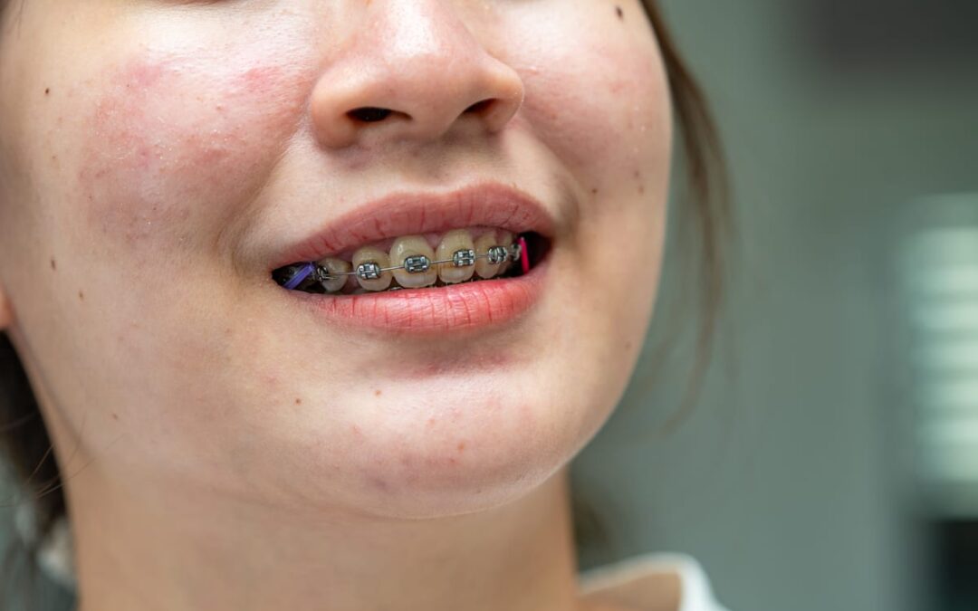 5 Questions About Braces Our Patients Ask Before Starting